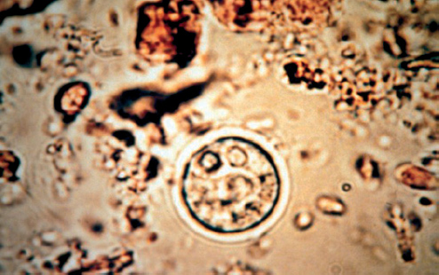Amibiase (amoebose) hépatique